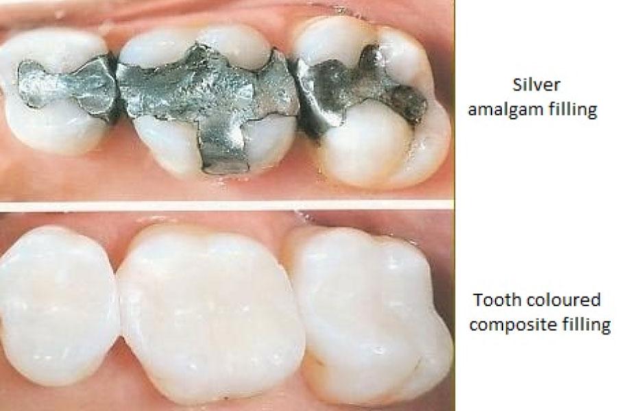 Key Tips ‌for Fillings‌ that Wow